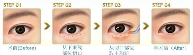 消眼袋黑眼圈的方法 怎么去黑眼圈眼袋 小方法