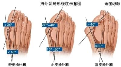 脚趾腱鞘炎佳治疗方法 脚趾腱鞘炎的治疗方法