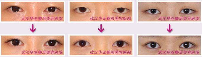 眼部除皱手术多少钱 眼部除皱术的分类