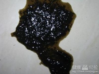 大便黑色是什么原因 大便黑色有哪些原因 大便黑色的原因