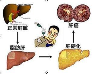 脂肪肝如何消除 脂肪肝怎么办