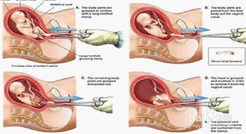 人工流产对女性的伤害 人工流产对女性身体的伤害多大