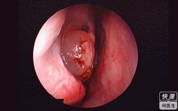 治鼻甲肥大的老偏方 鼻甲肥大最佳治疗方法