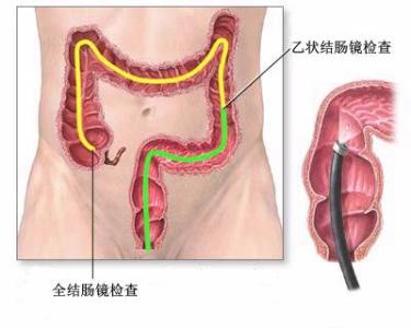 结肠黑变病的治疗 结肠黑变病的治疗方法