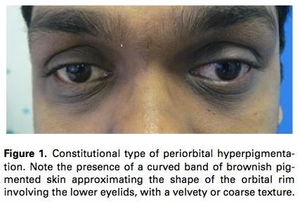 脑血栓形成的临床表现 黑眼圈如何形成的 黑眼圈的临床表现