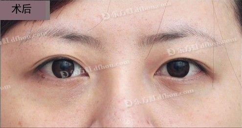 治疗黑眼圈的简单方法 怎么去黑眼圈 去黑眼圈简单方法
