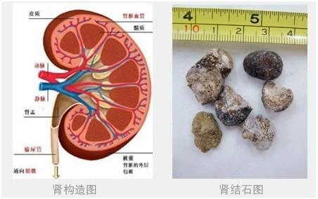 肾结石的形成与治疗 肾结石是怎么形成的 肾结石的治疗方法