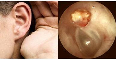 外耳道炎怎么治疗偏方 外耳道炎的治疗方法