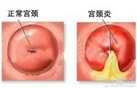 治疗急性宫颈炎疾病 什么是急性宫颈炎 急性宫颈炎的治疗