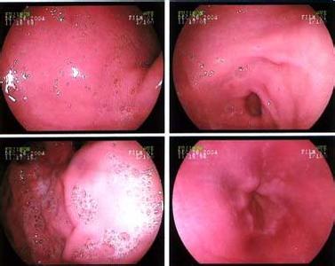 糜烂性胃炎治疗方法 糜烂性胃炎怎么调理 治疗糜烂性胃炎的方法