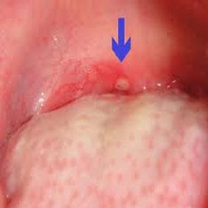 疱疹性口腔炎严重吗 什么是疱疹性口腔炎