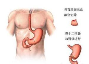 老年人胃出血怎么回事 胃出血是怎么回事