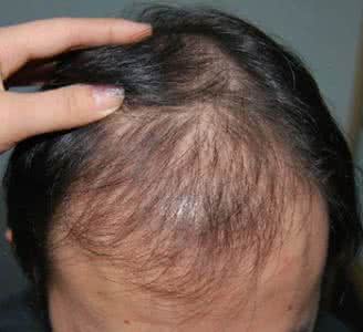 治疗脂溢性脱发偏方 脂溢性脱发有哪些治疗偏方