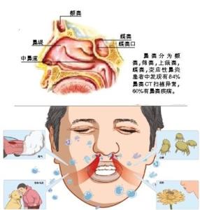 导致鼻炎的原因是什么 鼻炎是什么原因