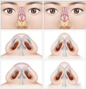 鼻尖整形术的方法 鼻尖整形的方法
