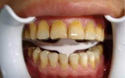 如何能把牙齿刷白 为什么牙齿刷不白