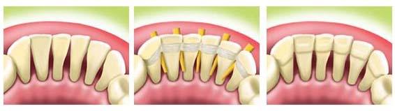 牙齿松动的8种治疗方法 牙齿出现松动怎么办
