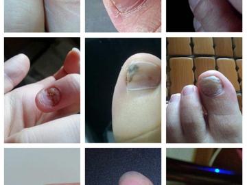 怎么治疗灰指甲最有效 得了灰指甲怎么治疗