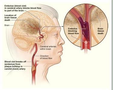 脑梗塞最佳治疗方法 有效治疗脑梗塞的方法