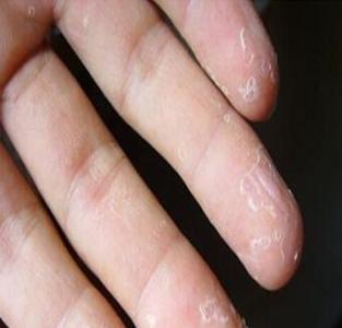 手指头脱皮是怎么治疗 手指经常脱皮是怎么回事