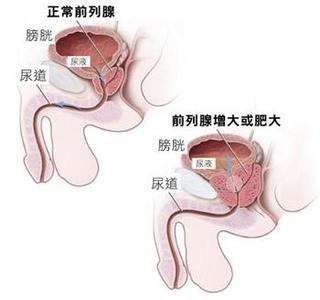 前列腺疼痛是在哪里痛 前列腺痛是什么原因