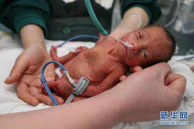 新生儿缺氧性脑改变 新生儿缺氧缺血性脑病的护理