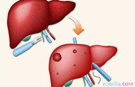 慢性肝炎有什么症状 慢性肝炎的常见症状有哪些