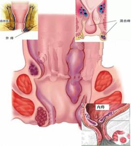 痔疮的形成与治疗 痔疮是如何形成的 痔疮的治疗方法