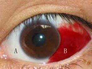 眼睛充血是什么原因 眼睛充血是什么原因_眼睛充血的原因