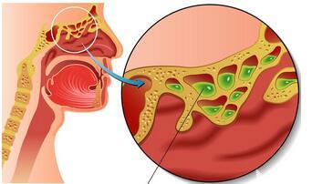鼻窦炎的形成 鼻窦炎是由什么形成的