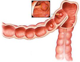 肠梗阻最佳治疗方法 肠梗阻的治疗方法有哪些 肠梗阻的治疗方法