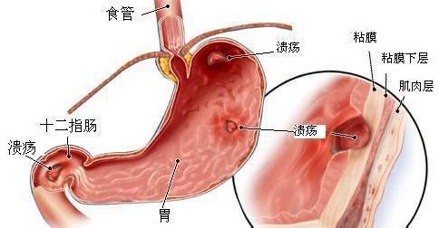 胃胀 吐酸水是怎么回事 胃吐酸水是怎么回事