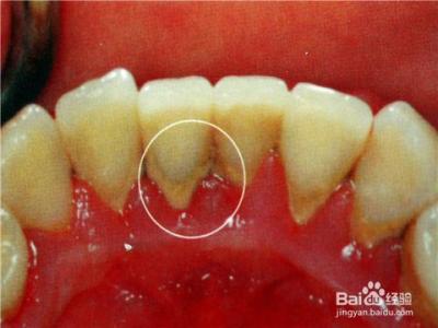牙石掉了一块怎么办 牙石是怎么回事