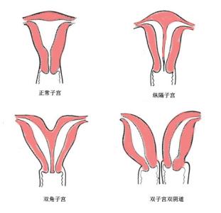 女性双子宫 女性双子宫的原因有什么