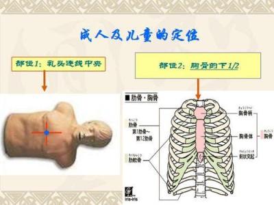 心肺复苏的步骤 心肺复苏急救方法