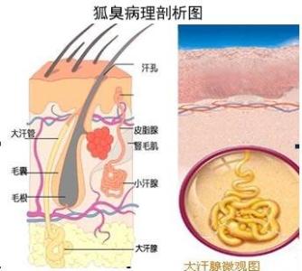 腋臭是什么原因 什么原因得腋臭