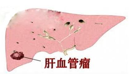 肝血管瘤形成的原因 肝血管瘤的原因是什么
