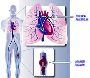 肺栓塞的原因 肺栓塞什么原因