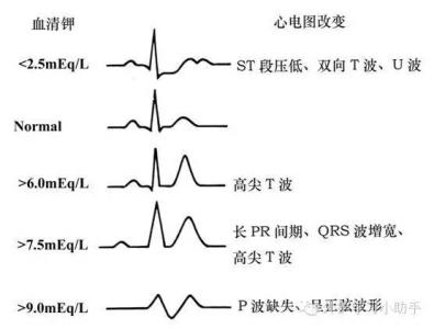 引起高钾血症的原因是 高钾血症的原因