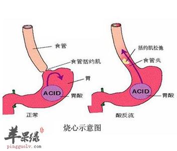 胃酸怎么回事,吐酸水 胃酸怎么回事