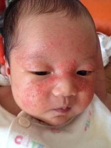新生儿湿疹的治疗方法 新生儿湿疹怎么治疗 婴儿湿疹治疗方法