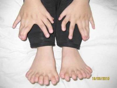 世界上脚趾最长的人图 世界上脚趾头最长的人