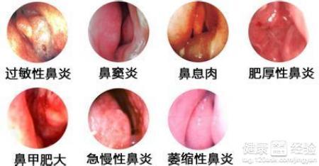 肥厚型鼻炎治疗费用 治疗肥厚性鼻炎的方法