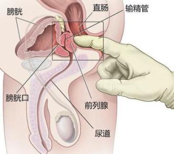 治疗前列腺增生的药物 怎样治疗前列腺增生