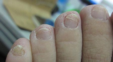 白醋治疗灰指甲的偏方 治疗灰指甲有什么偏方