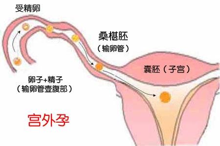 宫外孕原因有哪些 宫外孕的原因_宫外孕的原因有哪些