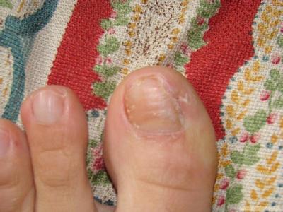 治疗灰指甲最好的偏方 灰指甲的有效治疗方法