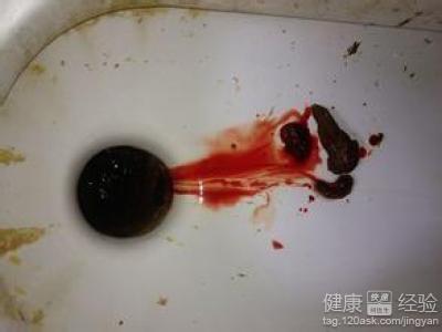 大便干燥出血怎么办 秋季大便干燥出血应该怎么办