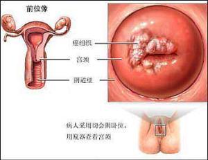 宫颈癌病因 什么是宫颈癌 宫颈癌病因 宫颈癌治疗