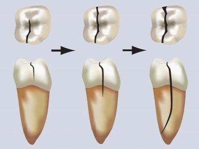 牙齿开裂是什么原因 牙齿开裂怎么治